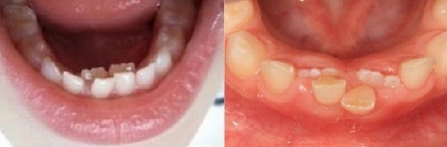Лечение молочных зубов у детей статья