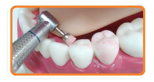Профессиональная чистка зубов с 40% скидкой!