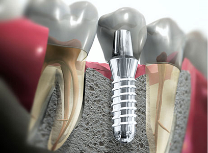 Имплантация в день удаления «Удалил зуб - получил сразу новый!» - гарантируют наши специалисты!