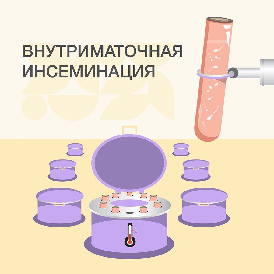 Внутриматочная инсеминация - статьи от специалистов клиники «Мать и дитя»